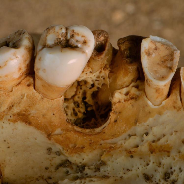 The upper teeth of an individual from the medieval period with a large gap in the row of teeth