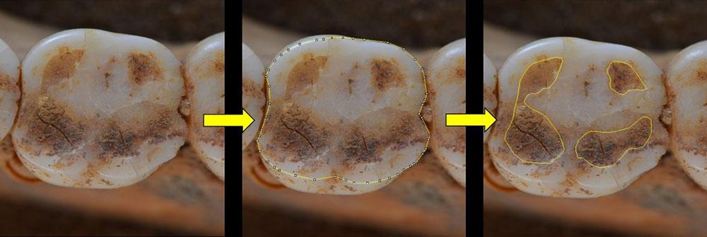 Digital recordings of the interior of a tooth showing exposed dentine and worn enamel